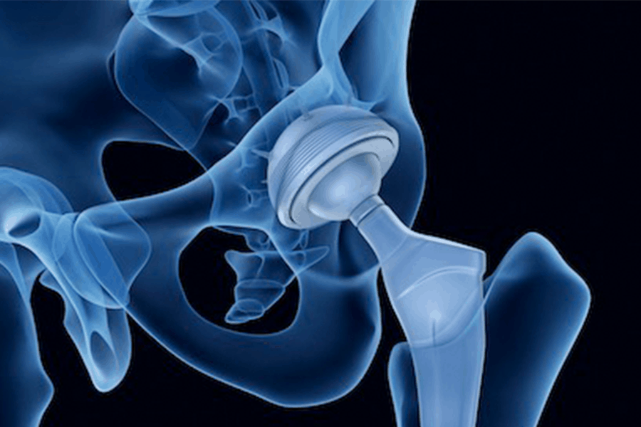 3D diagram of hip replacement