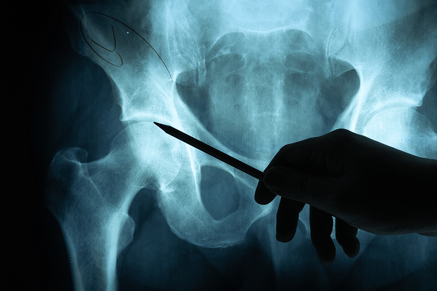 Specialist reviews x-ray film before Anterior Approach Hip Replacement